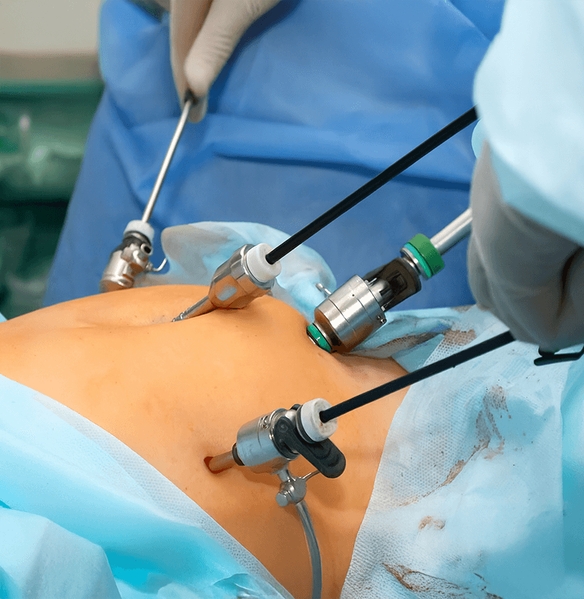 Laparoscopic Surgery